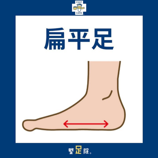 扁平足とは...