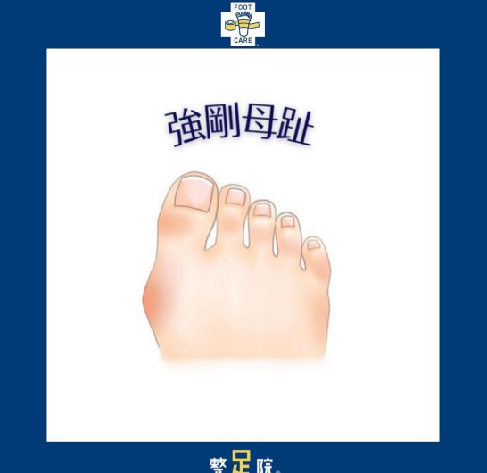 強剛母趾とは...